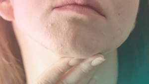 acne da mulher adulta